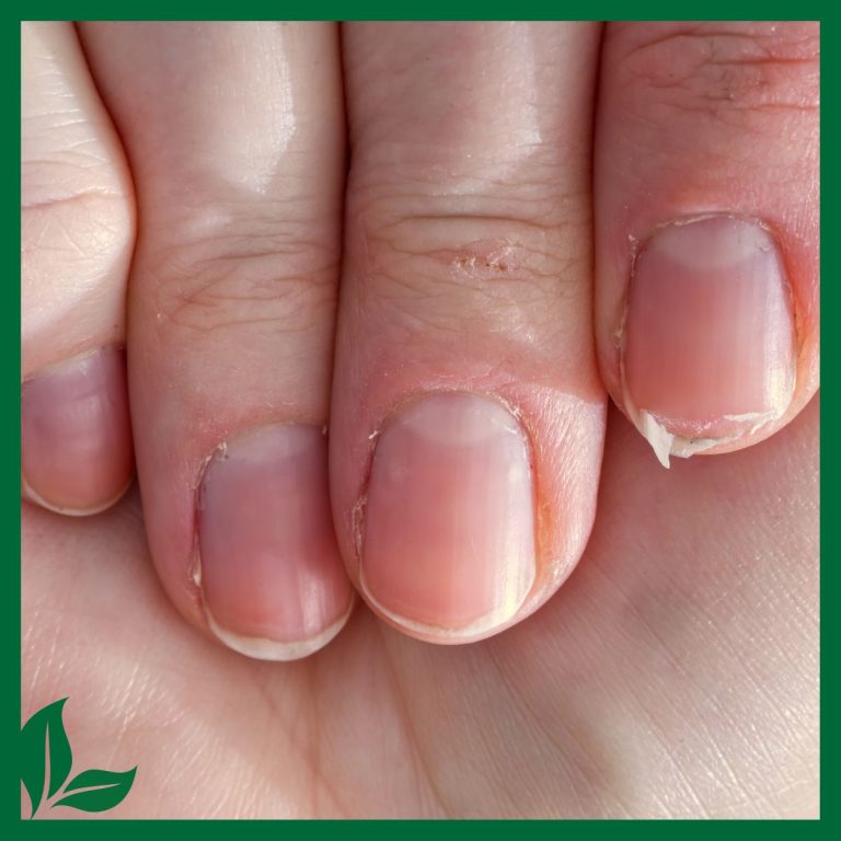 Closeup of a hand with brittle nails.