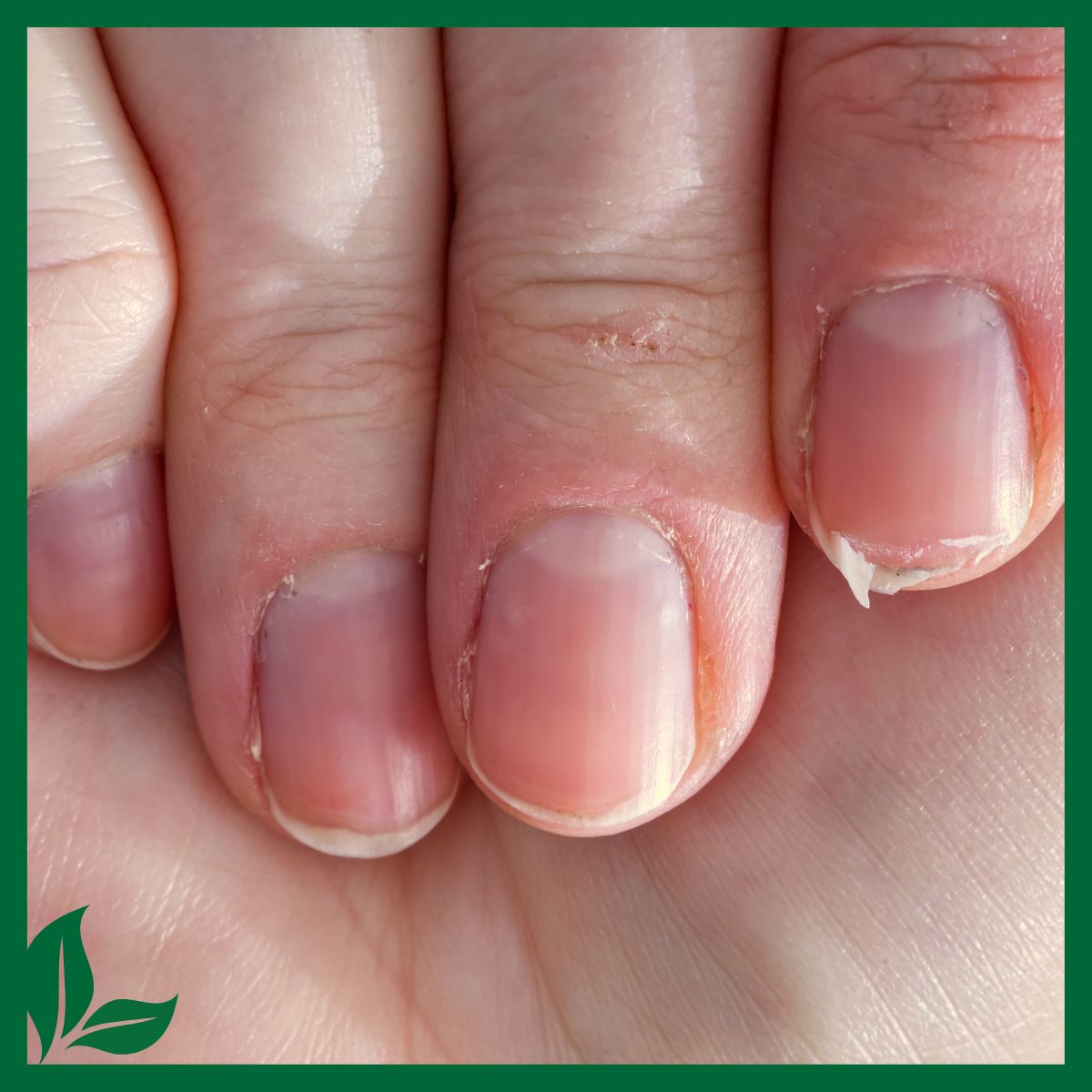 Closeup of a hand with brittle nails. 